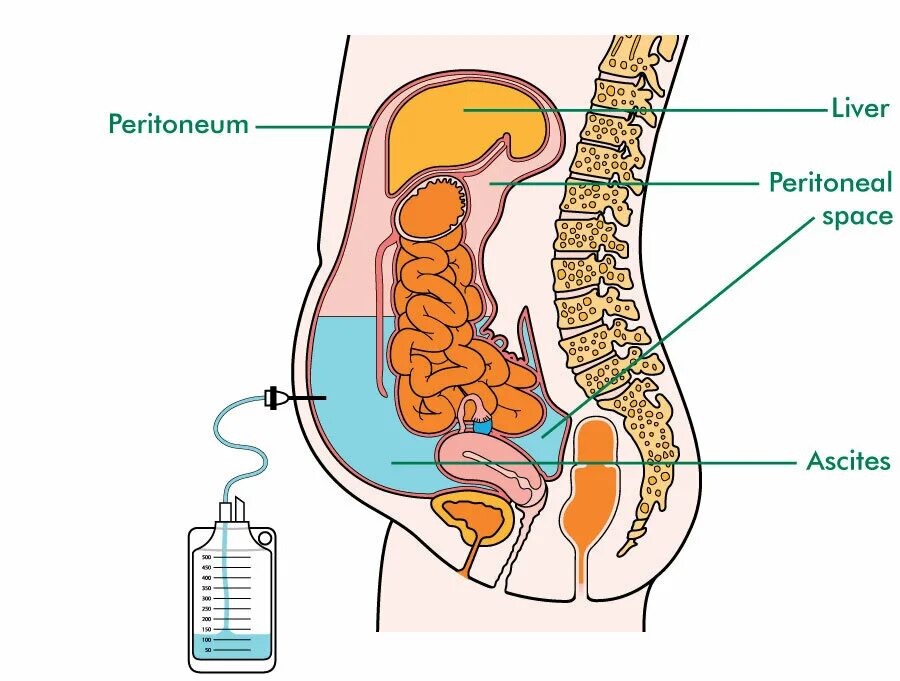асцит откачивание жидкости