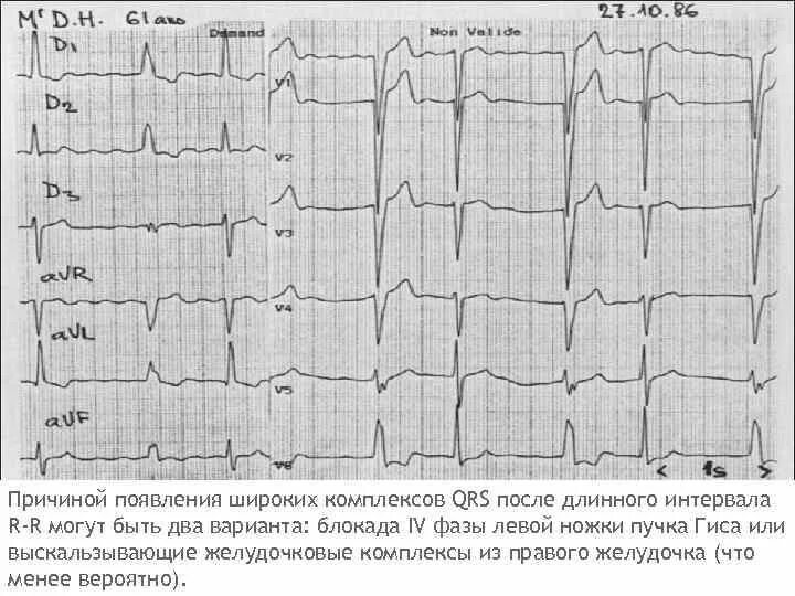 Аберрантные экстрасистолы на ЭКГ. Аберрантный комплекс QRS на ЭКГ. Аберрантное проведение на ЭКГ. Выскальзывающие комплексы из желудочков. Аберрантные экстрасистолы