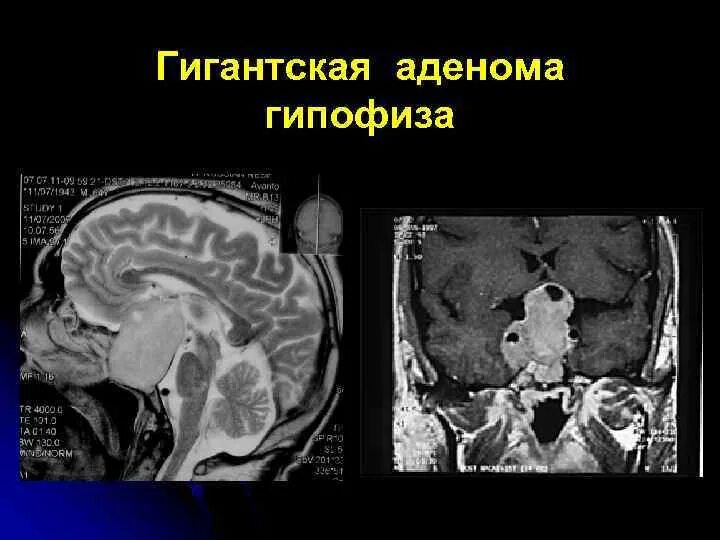 Аденома гипофиз мозга что это такое. Микроаденому гипофиза. Опухоль аденома гипофиза. Гормонопродуцирующая аденома гипофиза. Эндосупраселлярная аденома гипофиза.