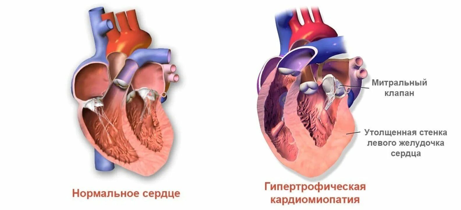 Гипертрофия левого желудочка гипертония. Гипертоническая болезнь и гипертрофия левого желудочка. Гипертрофия левого желудочка при гипертонической болезни. Гипертрофия левой желудочки сердце. Желудочка сердца расширена