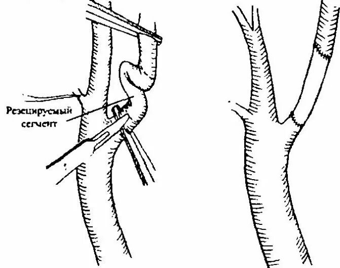 Изгиб вса. Резекция ВСА схема операции. Резекция внутренней сонной артерии с протезированием. Извитость наружной сонной артерии. Операция на сонной артерии при извитости.