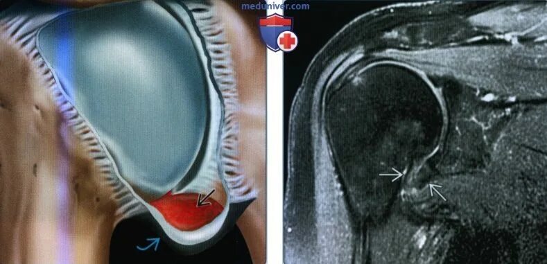 Капсулит симптомы и лечение. Капсулит плечевого сустава мрт. Адгезивный капсулит плечевого сустава мрт. Адгезивного капсулита плечевого сустава что это. Капсулит коленного сустава.