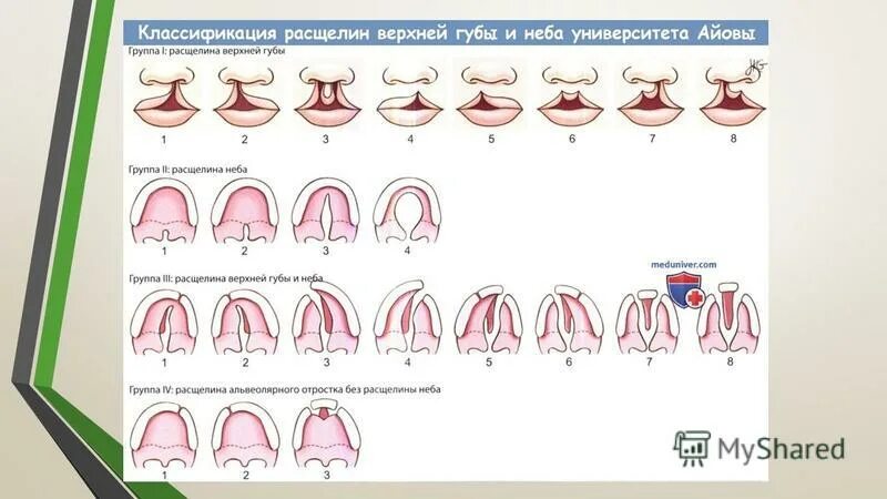развитие твердого неба