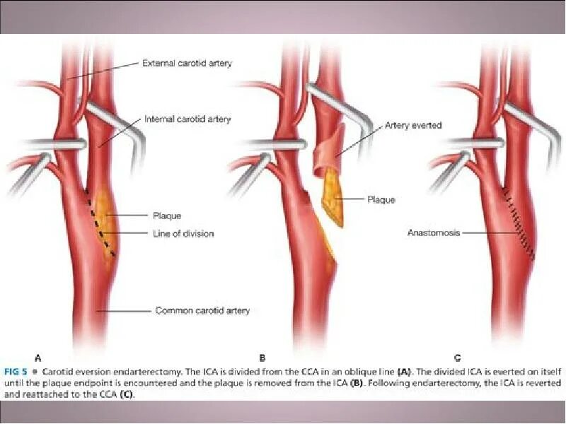Операция на артерии нижних