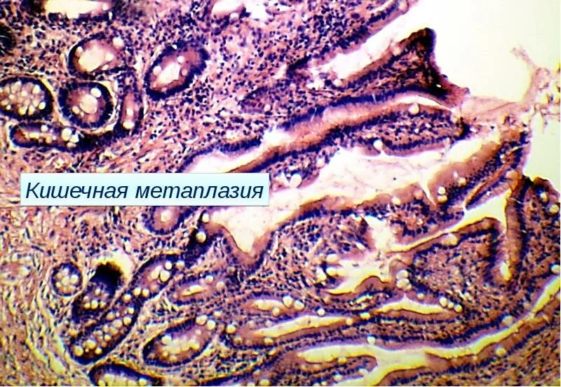 Полная метаплазия желудка. Атрофический гастрит кишечная метаплазия микропрепарат. Кишечная метаплазия желудка гистология. Кишечная метаплазия желудка микропрепарат. Кишечная метаплазия гистология.