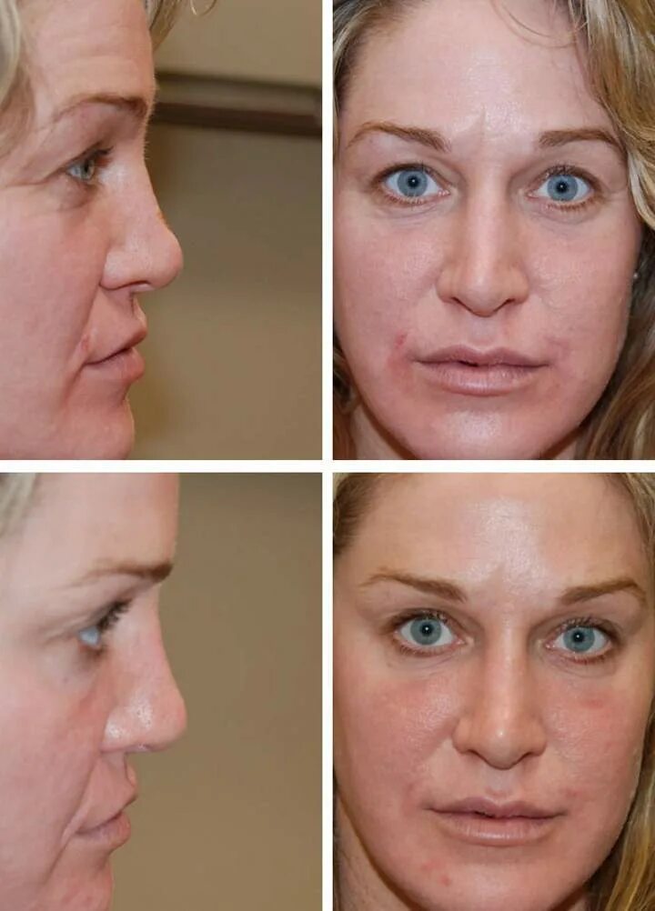 нос с помощью филлера. безоперационная ринопластика филлерами. безоперационная ринопластика носа. исправление формы носа филлерами. ринопластика носа гиалуроновой кислотой.