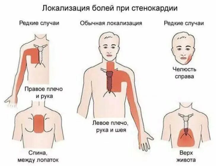 Почему при кашле боль. Стенокардия напряжения локализация боли. Типичная локализация боли при приступе стенокардии. Локализация боли при стенокардии напряжения. Болмпри стенокардии.