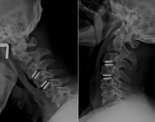 Диск с3 с4 с5 шейного отдела. 5 И 6 диск позвоночника. Протрузии шейного отдела с3-с4 с4-с5 с5-с6. Грыжа дисков с4 с5 с6 шейного отдела. Операция по замене позвоночника