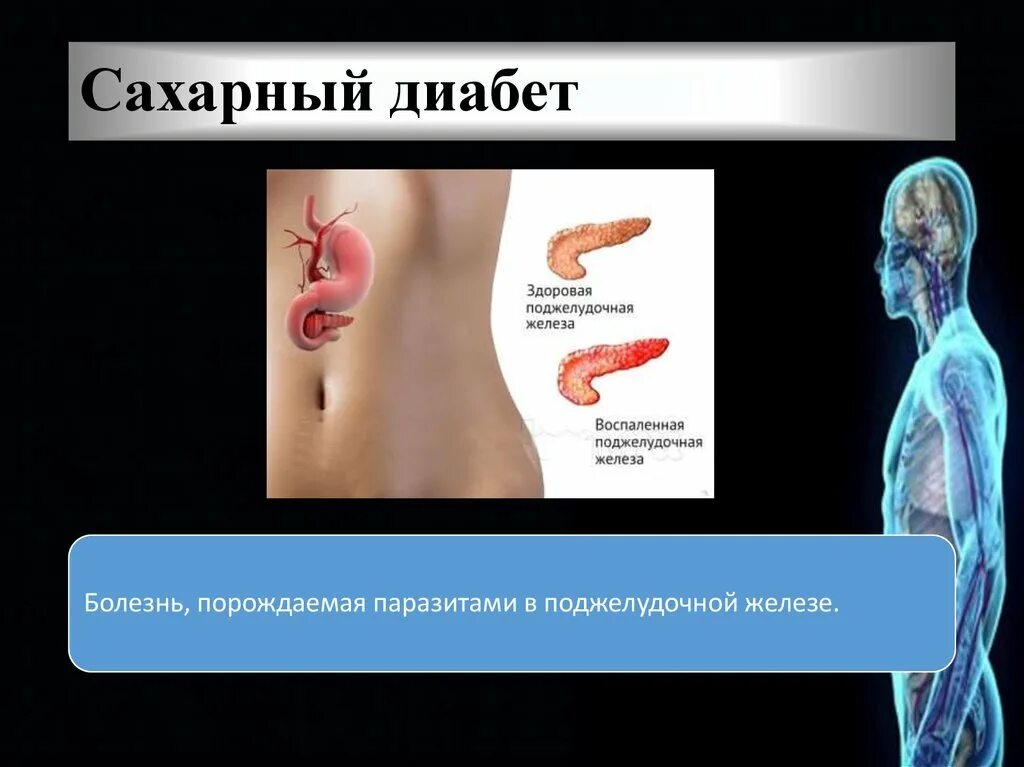 Пересадка поджелудочной при диабете. Поджелудочная железа при сахарном диабете. Болезни поджелудочной железы сахарный диабет. Сахарный диабет железа. Сахарный диабет поджелудочная.