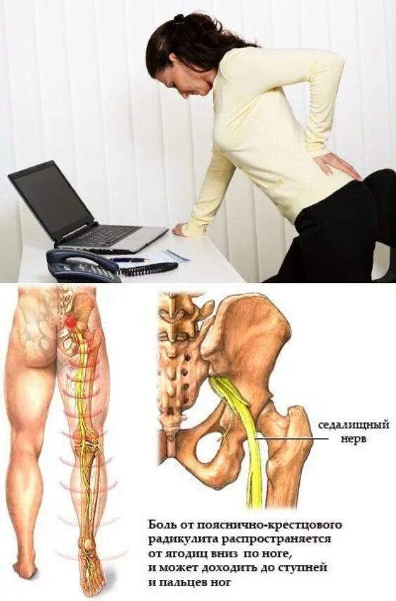 Симптомы поясничной радикулопатии. Пояснично-крестцовый радикулит симптомы. Радикулопатия поясничного отдела позвоночника. Дискогенная пояснично-крестцовая радикулопатия l5-s1 неврология. Радикулит пояснично кресцовой.