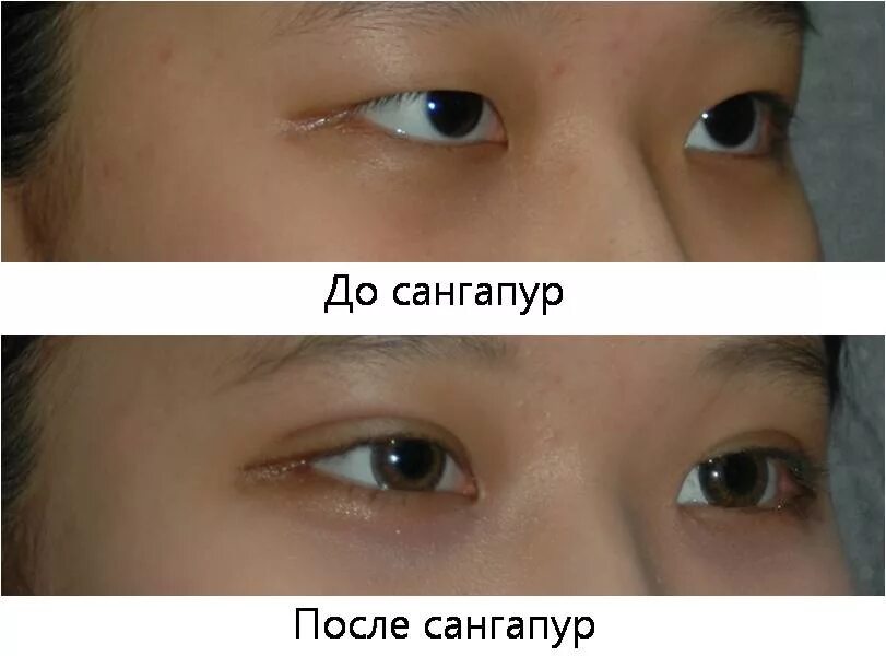 Операция сангапури. Блефаропластика сингапури. Нитевая блефаропластика Сингапуре.