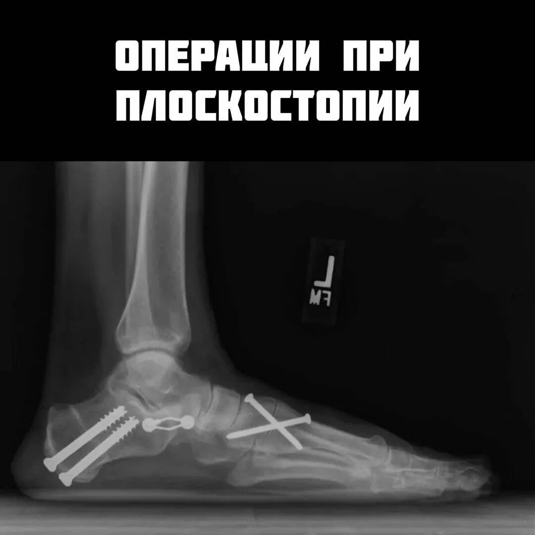 операция продольного плоскостопия. хирургическая операция при плоскостопии. операция продольного плоскостопия. операции по исправлению плоскостопия и вальгусной деформации. операция при продольном плоскостопии.