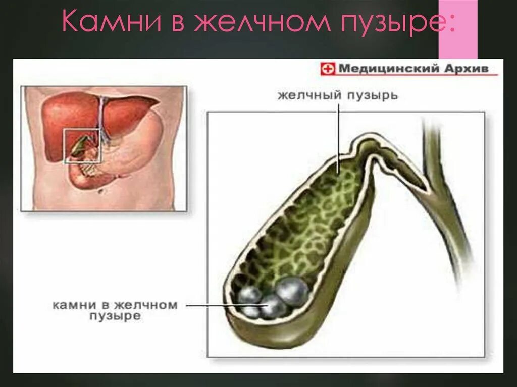 Симптомы желчного пузыря форум