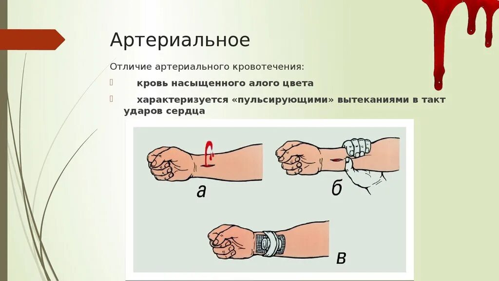 Ярко красный цвет крови является признаком. Артериальное кровотечение. Артериальное кровотечение кровь. Артериальное и венозное кровотечение. Венозное и артериальное кровотечение цвет.