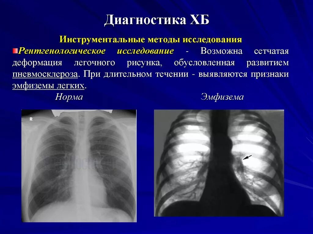 Умеренные фиброзные изменения