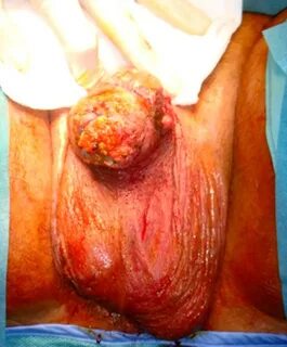 Kevins penectomy - funphotoguys.com.