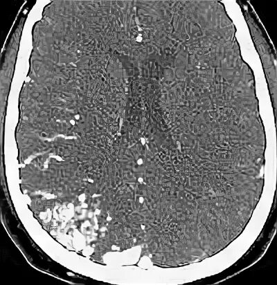 Сосудистая аномалия. Артериовенозная мальформация головного мозга на кт. Артериовенозная мальформация на кт головы. Сосудистая мальформация головного мозга на кт.