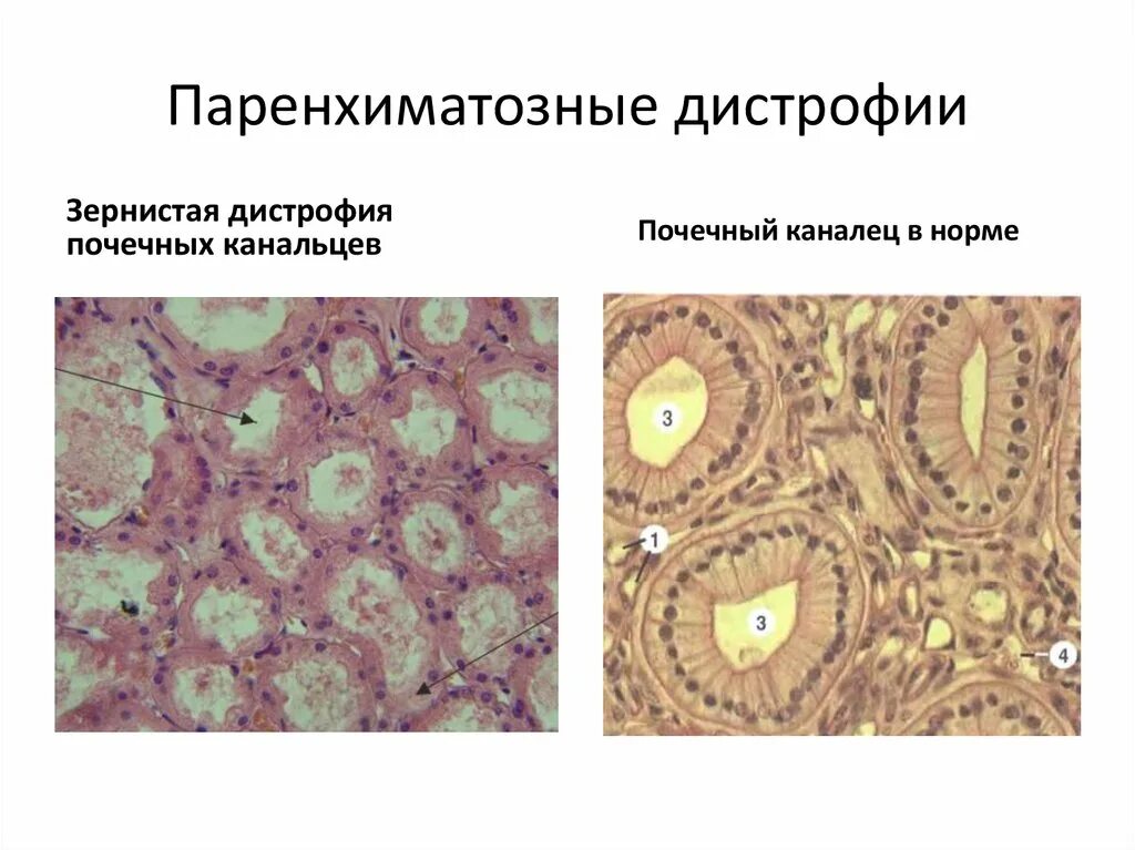 Паренхиматозная белковая зернистая дистрофия. Зернистая дистрофия схема. Клеточные паренхиматозные дистрофии. Паренхиматозная дистрофия углеводная макроскопические.