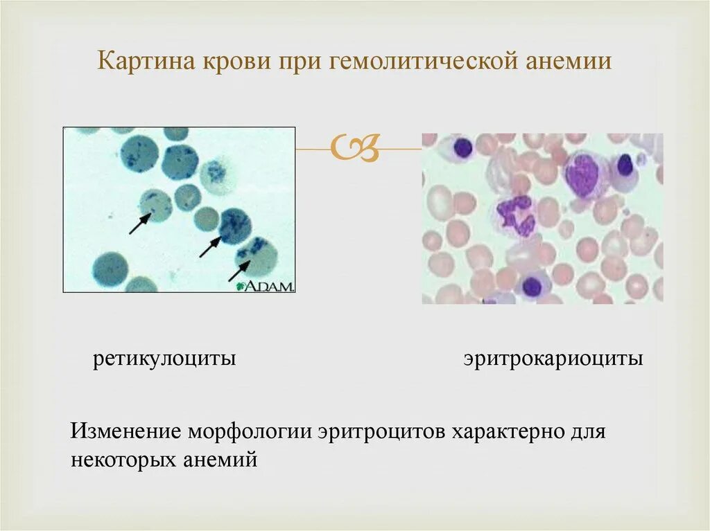 Ретикулоциты морфология. Ретикулоциты микроскопия. Ретикулоциты классификация. Изменение морфологии эритроцитов при анемиях.