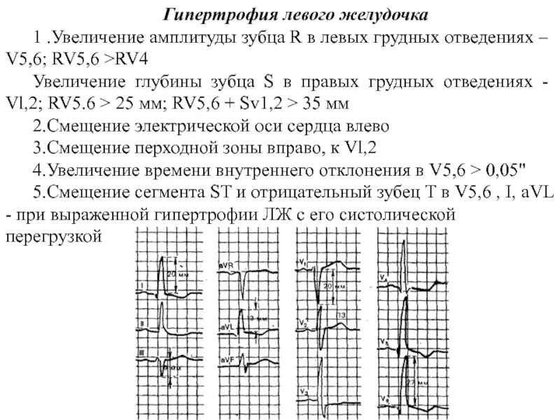 Гипертрофия правого желудочка на ЭКГ v5 v6. Rv4 rv5 на ЭКГ. Зубец s при гипертрофии левого желудочка. Повышенная электрическая активность левого желудочка на ЭКГ. Экг преобладание левого желудочка