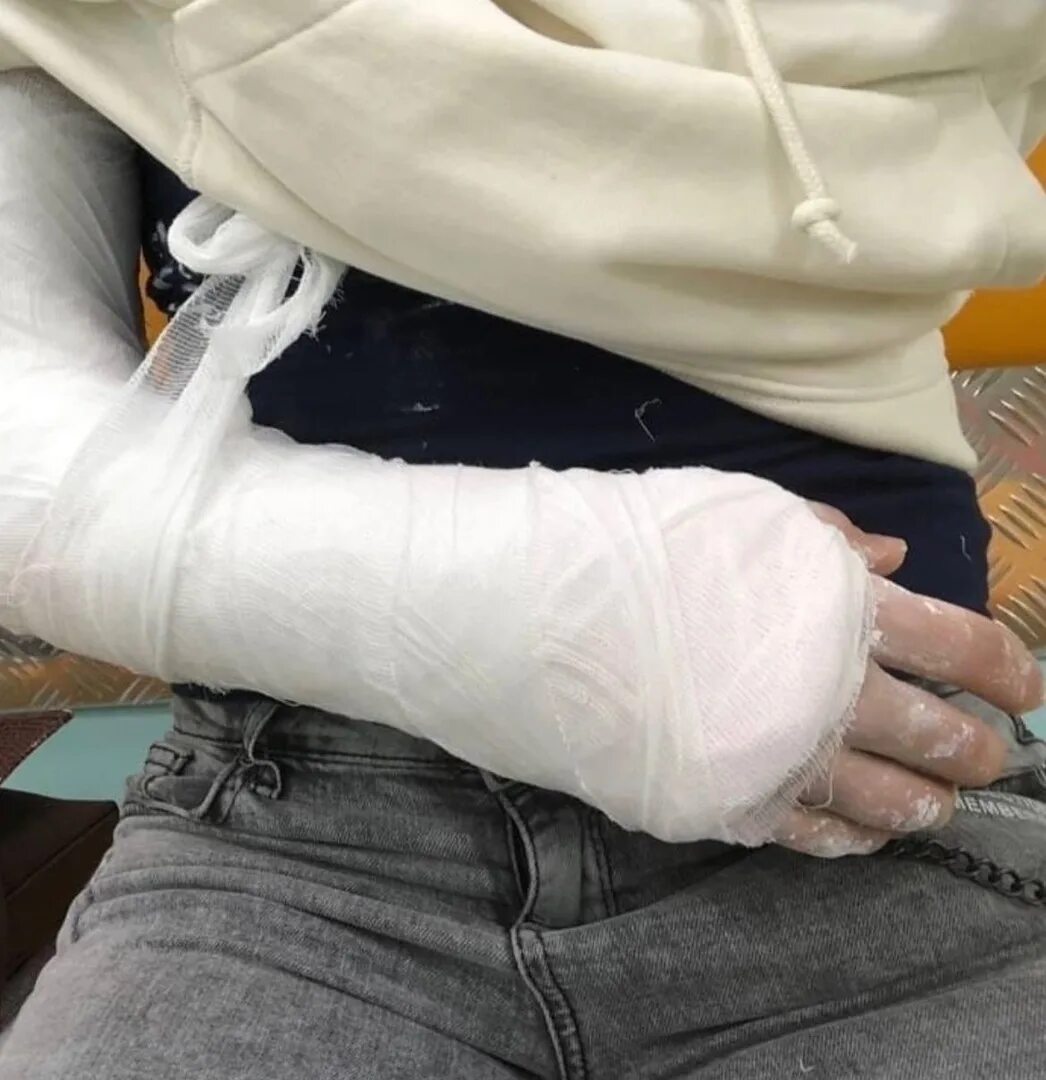 Хожу с гипсом на руке. Хожу с гипсом на руке