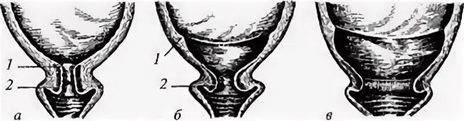 Маточный зев. Наружный зев щелевидный что это. Т-образный зев шейки матки. Шейка 25 мм внутренний зев т образный.