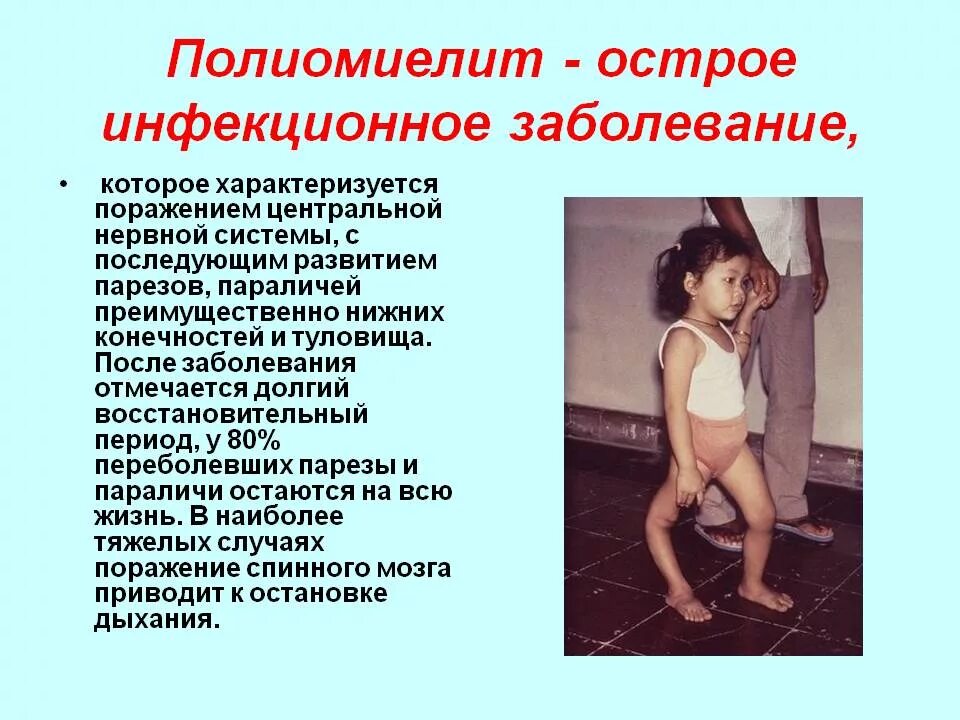 полиомиелит что это за болезнь