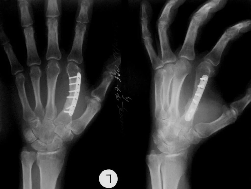 перелом 2 пястной кости кисти. перелом 2 пястной кости кисти. перелом 3 пястной кости. перелом диафиза 5 пястной кости. перелом диафиза 5 пястной кости.