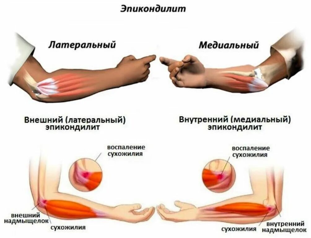 Латеральный эпикондилит сухожилие. Воспаление локтевого сустава эпикондилит. Внешний надмыщелок локтевого сустава. Латеральный эпикондилит локтевого сустава.