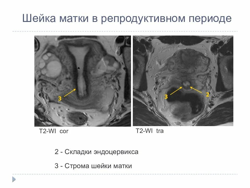 Шейка матки анатомия мрт. Мрт эндометрия