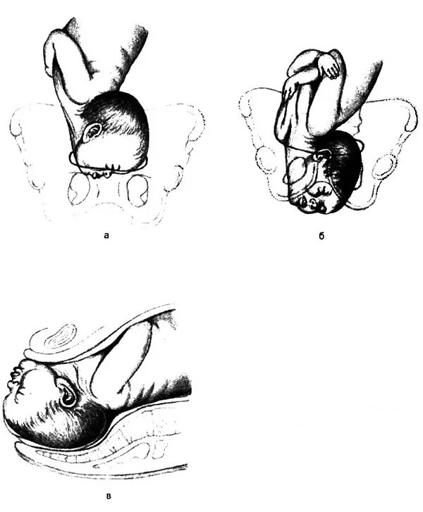 Правильное предлежание. Лицевое предлежание плода биомеханизм. Лицевое предлежание плода биомеханизм родов. Лобное предлежание плода биомеханизм родов. Биомеханизм при лицевом предлежании.