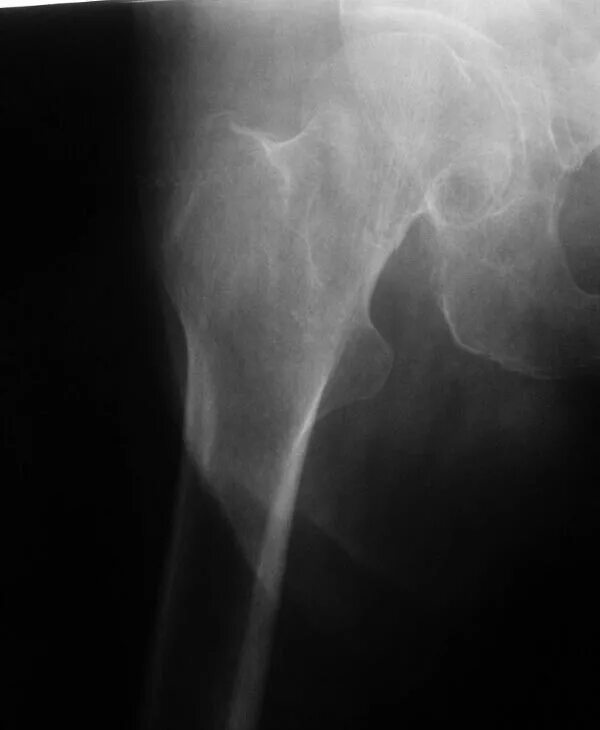 виды переломов шейки бедренной кости.