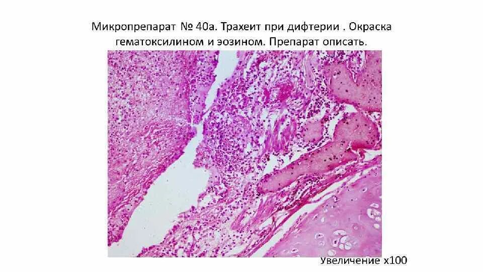 Бронхит микропрепарат. Дифтерическое воспаление зева. Фибринозное воспаление трахеи микропрепарат. Патанатомия дифтерия препарат. Дифтерический тонзиллит микропрепарат.