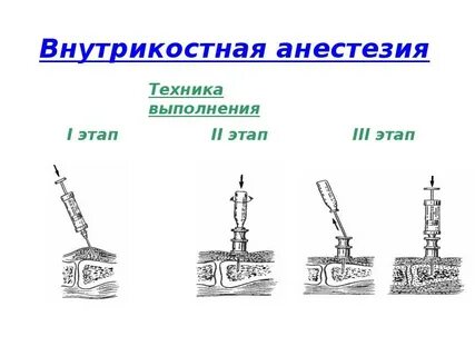 Анестезия в травматологии