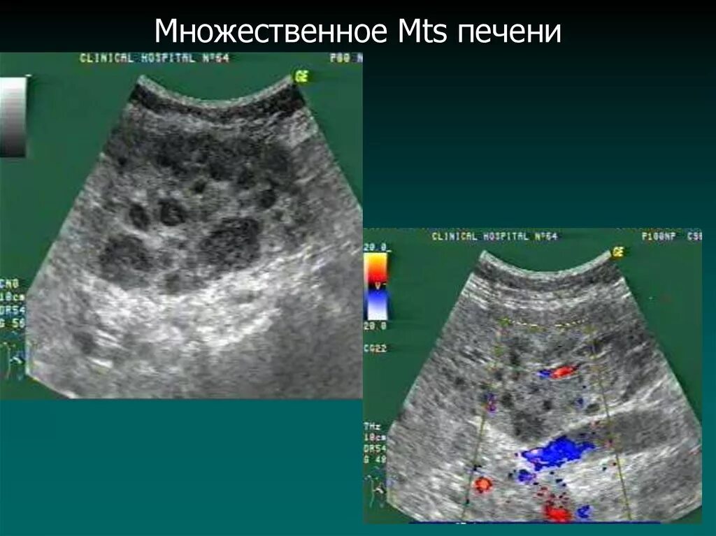 Множественные МТС В печени. Множественные MTS печени что это. Вылечить метастазы в печени