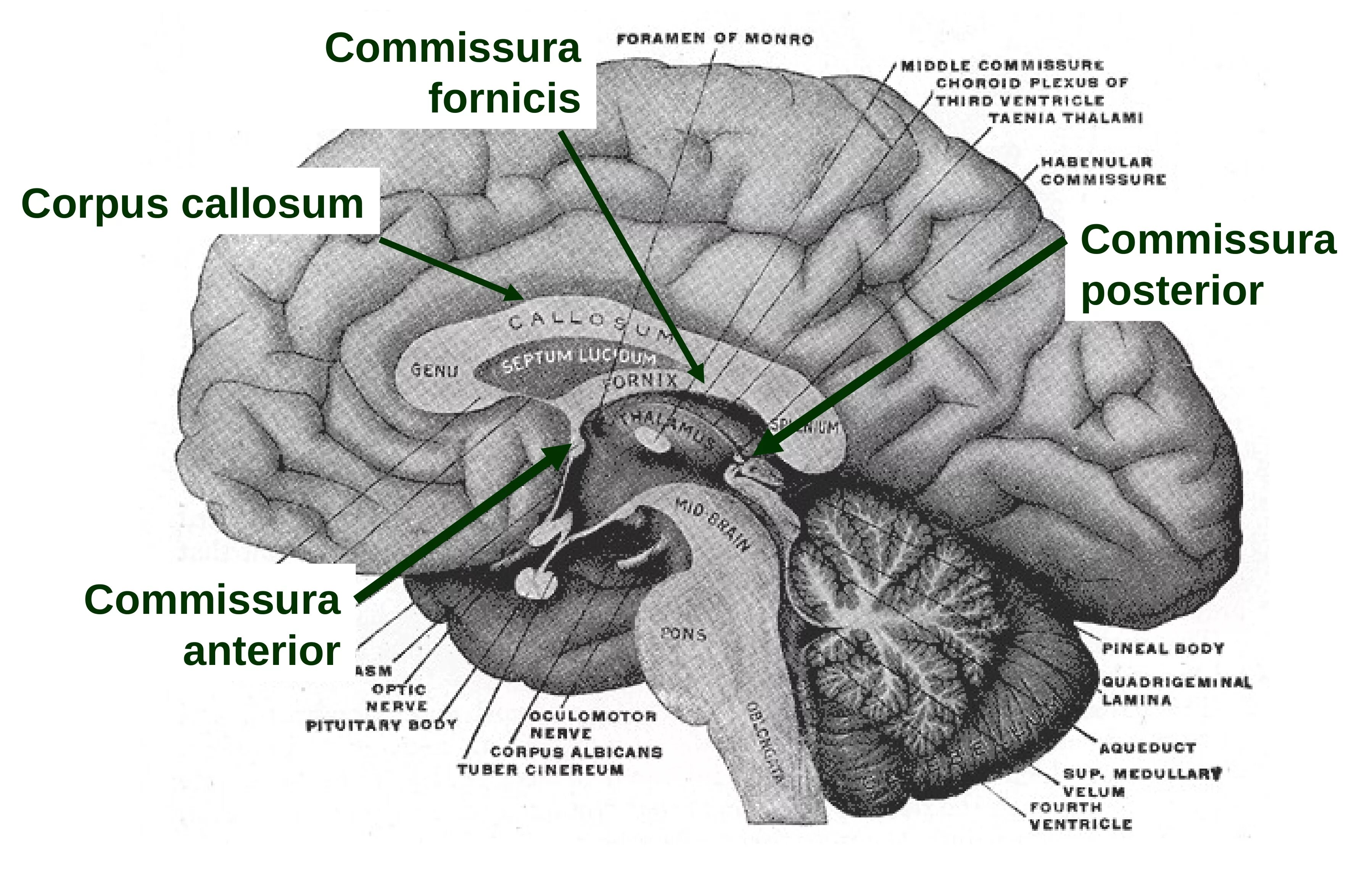 Комиссура Антериор. Сагиттальный срез мозга. Эпиталамическая спайка промежуточного мозга. Медиальная поверхность головного мозга. Воспаление головного мозга латынь