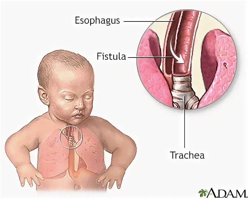 Пищевод у новорожденного. Трахея у новорожденного ребенка.