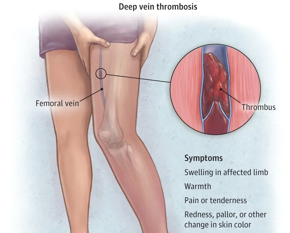 Тромб в артерии симптомы. Илеофеморальный флеботромбоз клиника. Илеофеморальный венозный тромбоз. Илеофеморальный венозный тромб. Флебит тромбофлебит флеботромбоз.