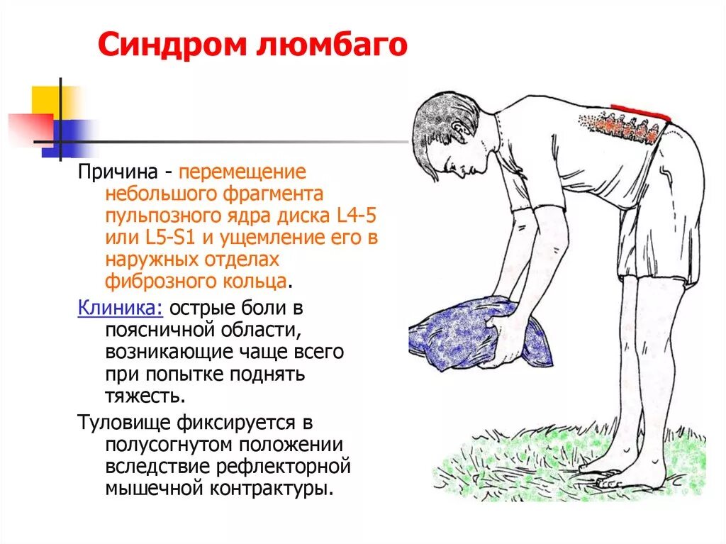 Люмбаго. Люмбаго симптомы. Люмбаго поясничный прострел.