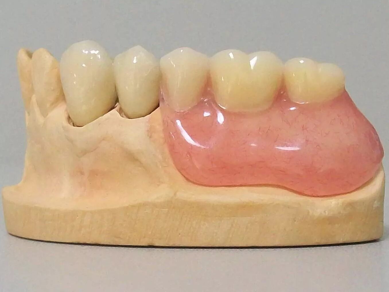 Конструкции съемных протезов. 036. Конструкции съемных протезов. Моделировка базиса верхней челюсти. Съёмный бюгельный протез на верхнюю челюсть.