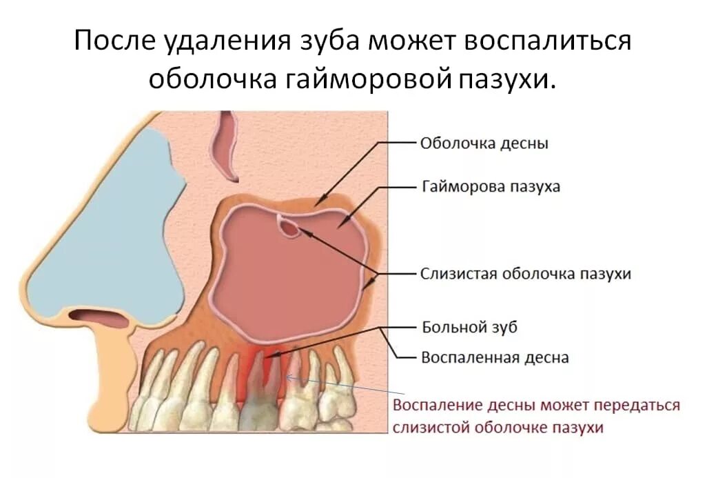 Одонтогенное воспаление верхнечелюстной пазухи гайморит. Острое воспаление гайморовых пазух. Катаральный одонтогенный гайморит. Острый одонтогенный верхнечелюстной синусит симптомы. Слизистая оболочка уха