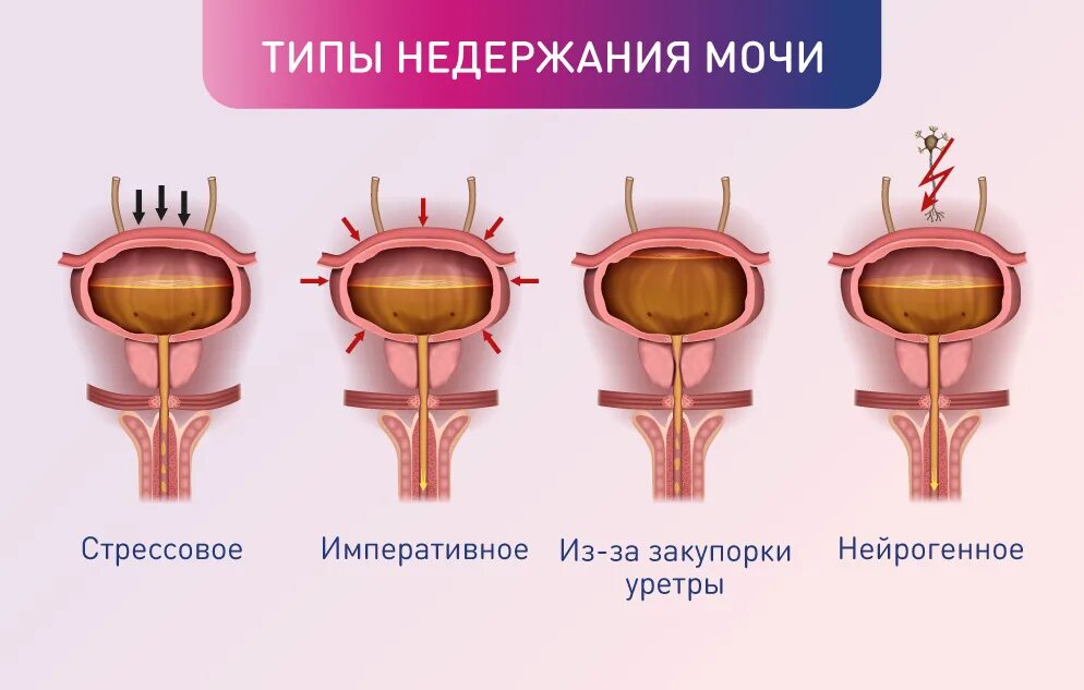 Мужчина 70 лет недержание мочи лечение. Парадоксальная ишурия. Дизурические расстройства недержание мочи. Дизурия у детей. Дизурия что это такое у женщин.