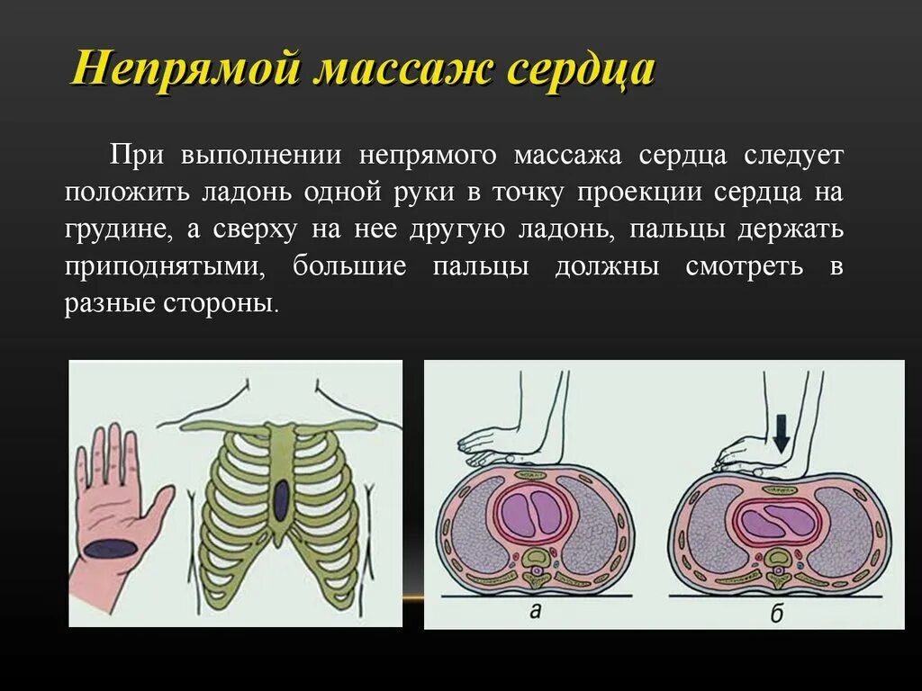 Что такое непрямой массаж сердца. Не прямлй массаж сердца. пе прямой массаж сердца. непрямойтмассаж сердца. не примой масаж сердце.