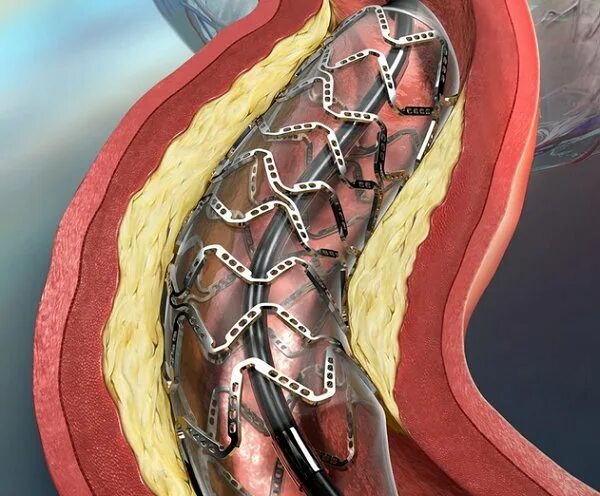 Инфаркт коронарное стентирование. ТРАНСЛЮМИНАЛЬНАЯ ангиопластика сосудов. Стентирование сосудов сердца топографическая анатомия. ТРАНСЛЮМИНАЛЬНАЯ коронарная ангиопластика. Стентирование подключичной артерии.