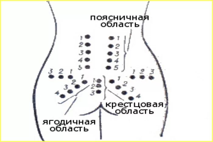 Точечный массаж пояснично-крестцового отдела. Гирудотерапия схема постановки пиявок на крестец. Точки акупунктуры при грыже позвоночника поясничного отдела. Точечный массаж спины схема.