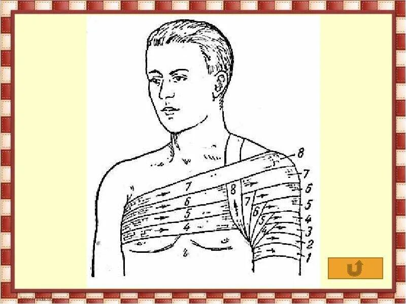 Техника наложения повязки на плечо. Перевязка колосовидная на плечо. Колосовидная повязка на плечевой сустав. Колосовидная повязка на плечо алгоритм. Колосовидная бинтовая повязка.
