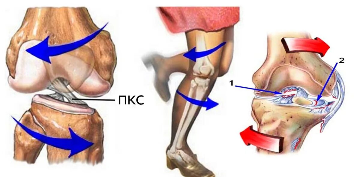 Скрип в коленях. Разрыв ПКС коленного сустава. Разрыв мениска механизм травмы. Механизм травмы передней крестообразной связки коленного сустава. Коленка крестообразная связка.