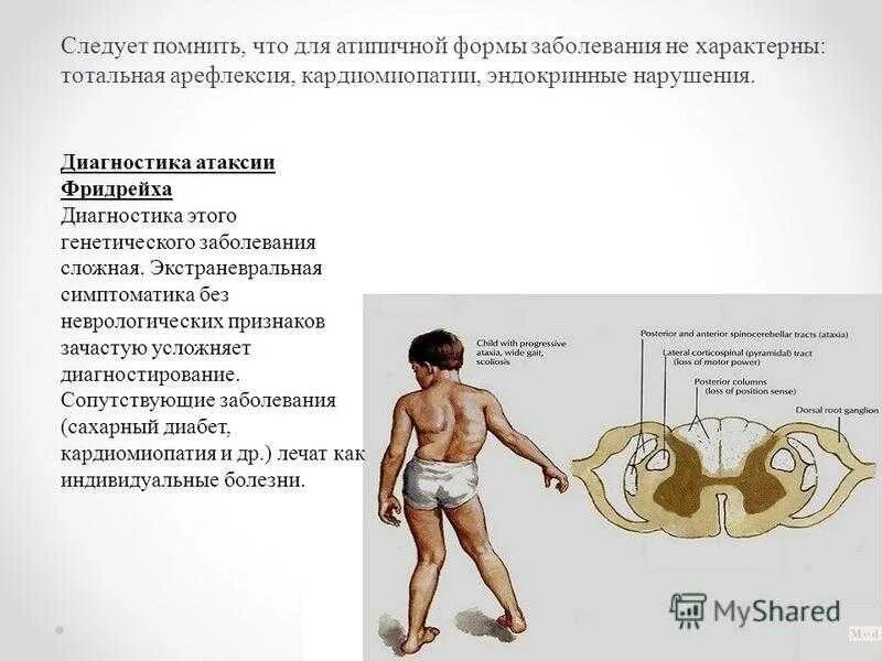 Атаксия при движении. Мозжечковая атаксия фридрейха. атаксия фридрейха генетика. диагноз атаксия фридрейха. атаксия фридрейха диагностика.