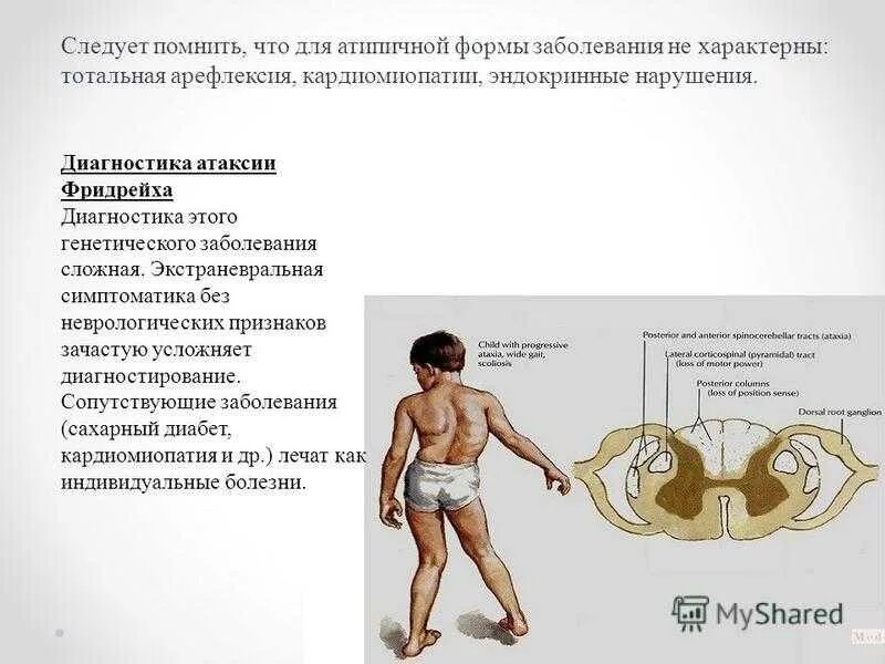 Мозжечковая атаксия Фридрейха. Диагноз атаксия Фридрейха. Атаксия Фридрейха генетика. Болезнь Фридрейха неврология. Наследственная атаксия