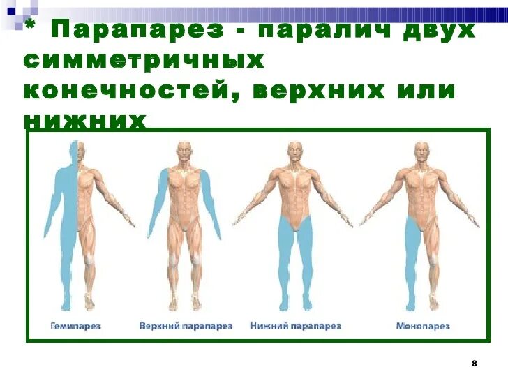 Парез верхних конечностей. Нижний спастический парапарез. Левосторонний парапарез. Периферический парапарез нижних конечностей. Верхний периферический парапарез.